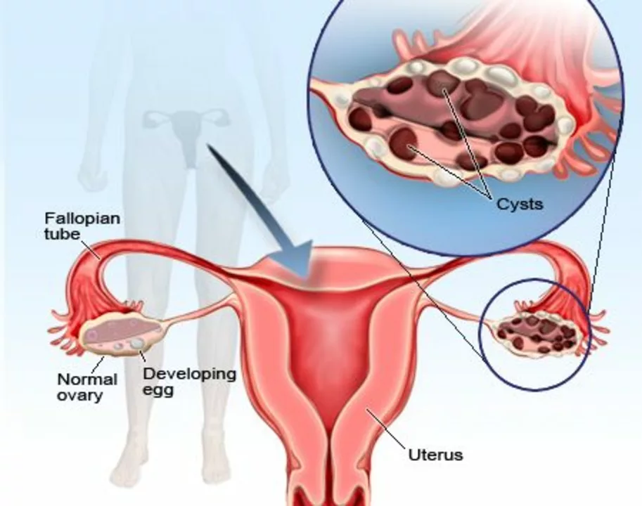 The Connection between Amenorrhea and Polycystic Ovary Syndrome (PCOS)